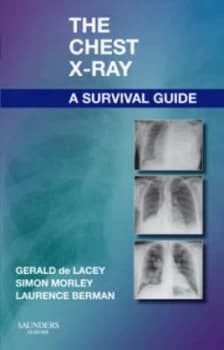 The Chest X-Ray by Gerald De Lacey Paperback