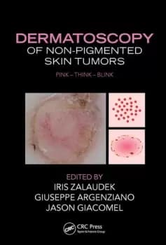 Dermatoscopy of Non-Pigmented Skin TumorsPink - Think - Blink