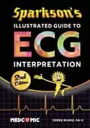 sparksons illustrated guide to ecg interpretation 2nd edition